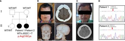 Aberrant activation of TGF-β1 induces high bone turnover via Rho GTPases-mediated cytoskeletal remodeling in Camurati-Engelmann disease